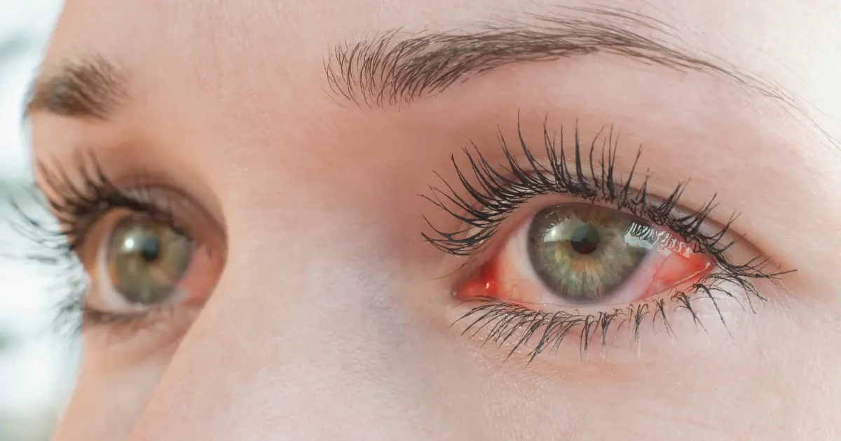 Augentropfen gegen rote Augen, Augenrötung